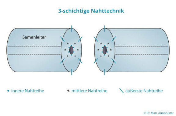 Grafik Refertilisierung, Urologie Kirchheim unter Teck, Dr. med. Armbruster