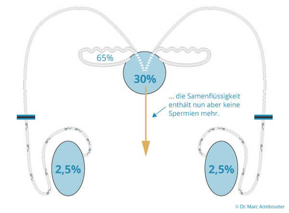 Grafik Samenflüßigkeit, Urologie Kirchheim unter Teck, Dr. med. Armbruster