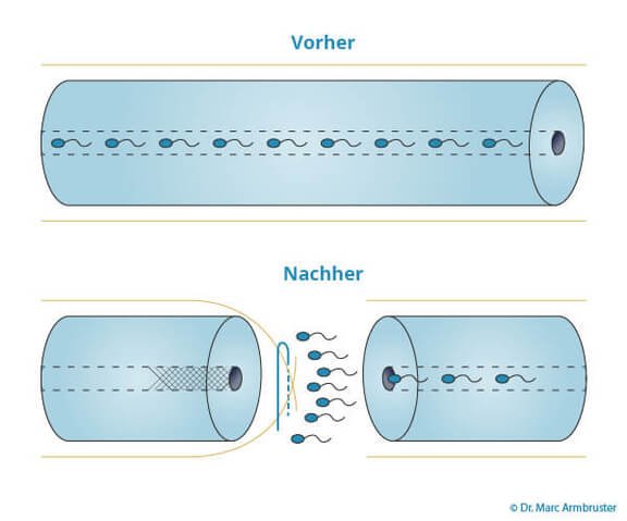 Grafik Vasektomie Vorher-Nachher, Urologie Kirchheim unter Teck, Dr. med. Armbruster