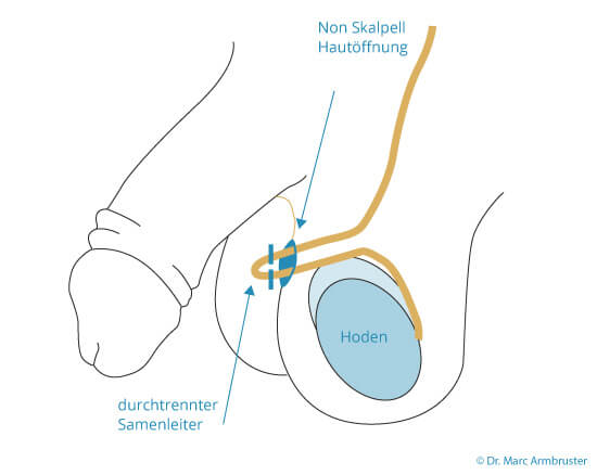 Grafik Sterilisation, Urologie Kirchheim unter Teck, Dr. med. Armbruster