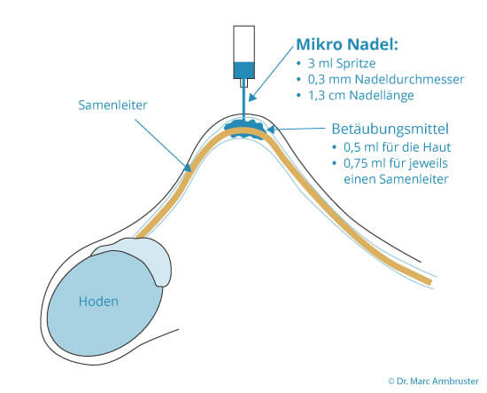 Grafik Vasektomie Betäubung, Urologie Kirchheim unter Teck, Dr. med. Armbruster